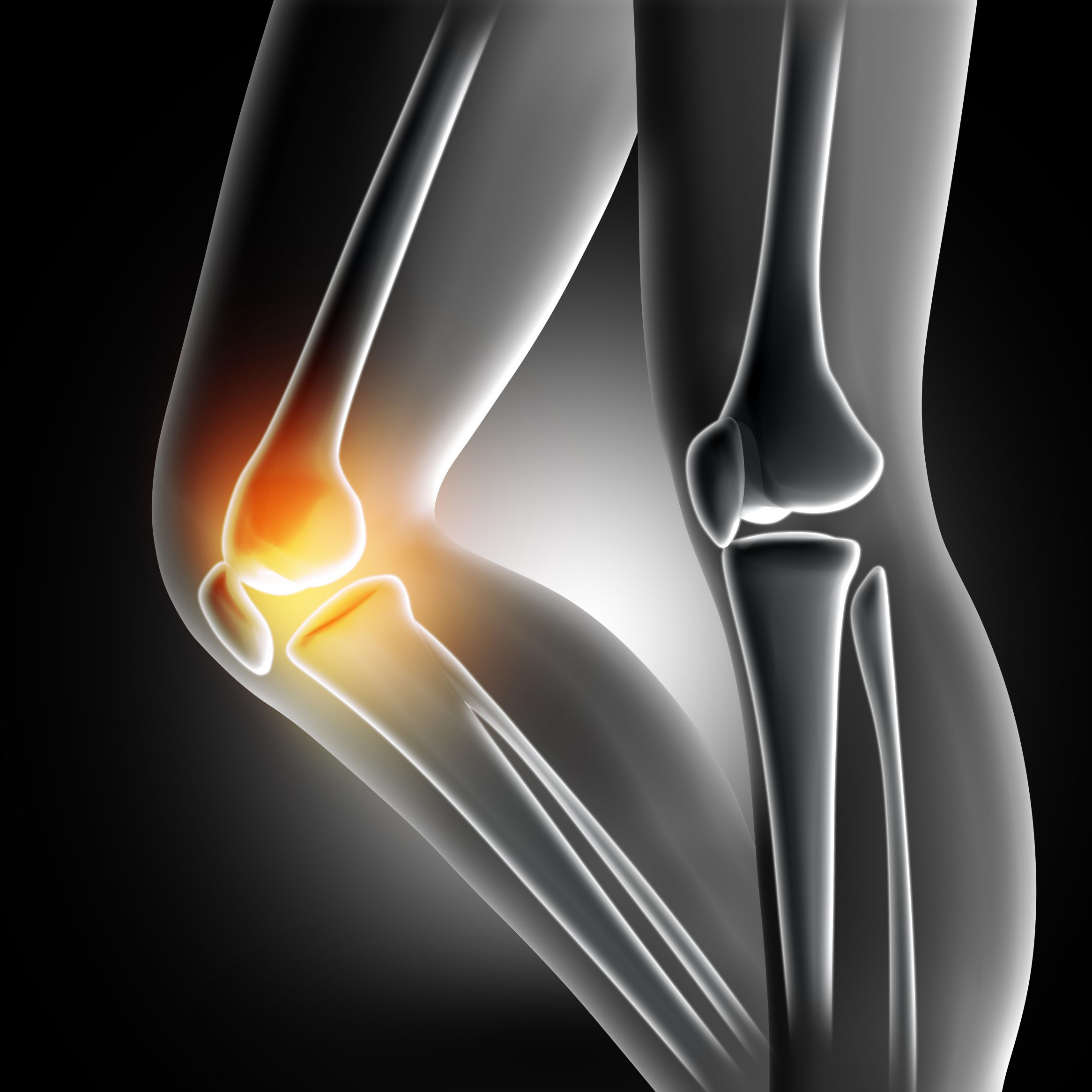 ACL Reconstruction Hamstring Tendon