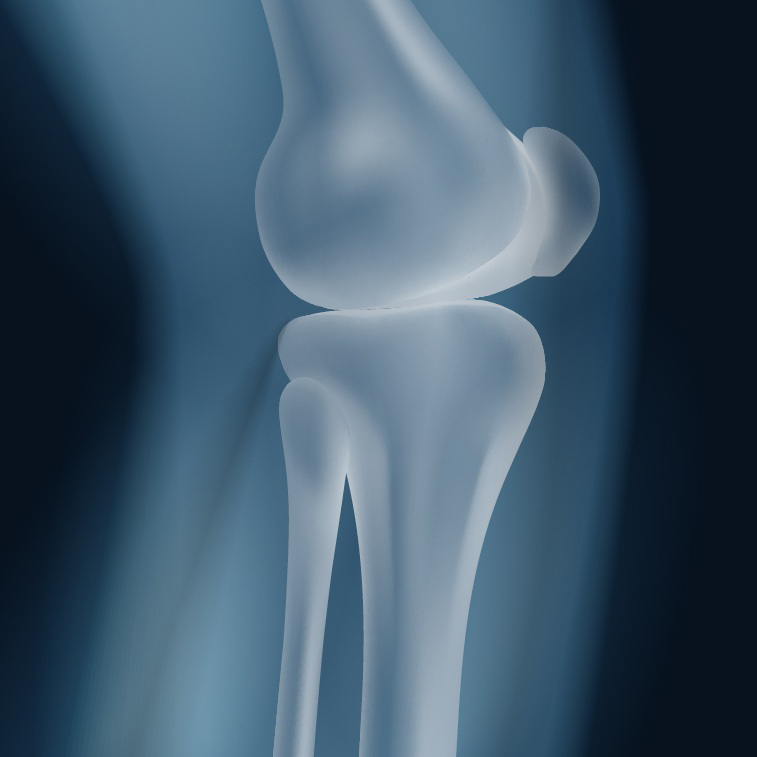 Knee Arthrosocopy- Surgery