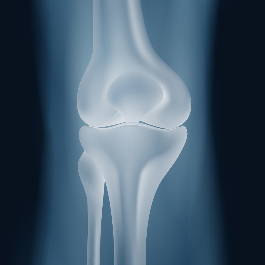 Revision Knee Replacement