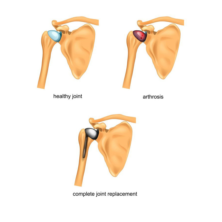 Shoulder Arthroscopy