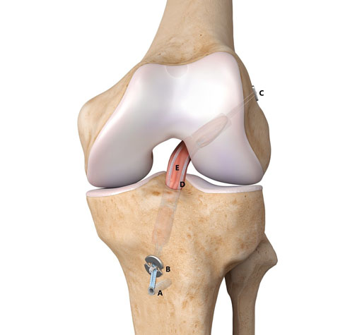 Arthroscopic ACL/PCL Reconstruction