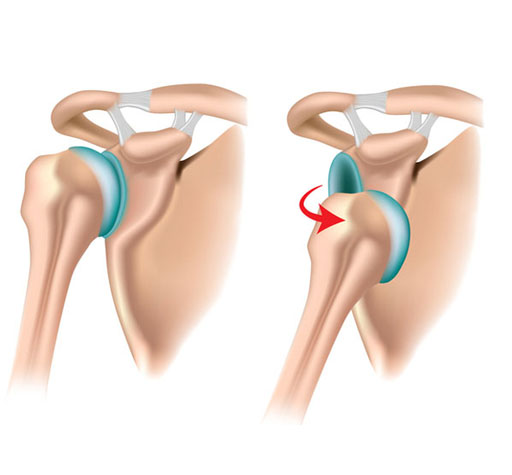 Arthroscopic Bankart Repair(Shouder Dislocation)