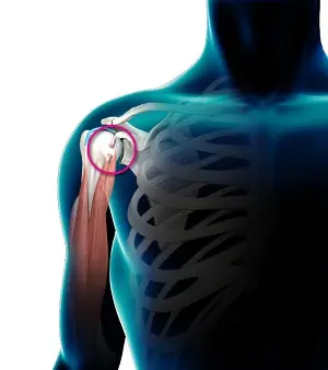 Biceps Tenodesis Advanced Shoulder Treatment by Dr. Vivek Bansal