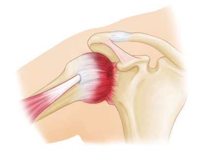 Frozen Shoulder Insights and Treatment by Dr. Vivek Bansal in Chandigarh