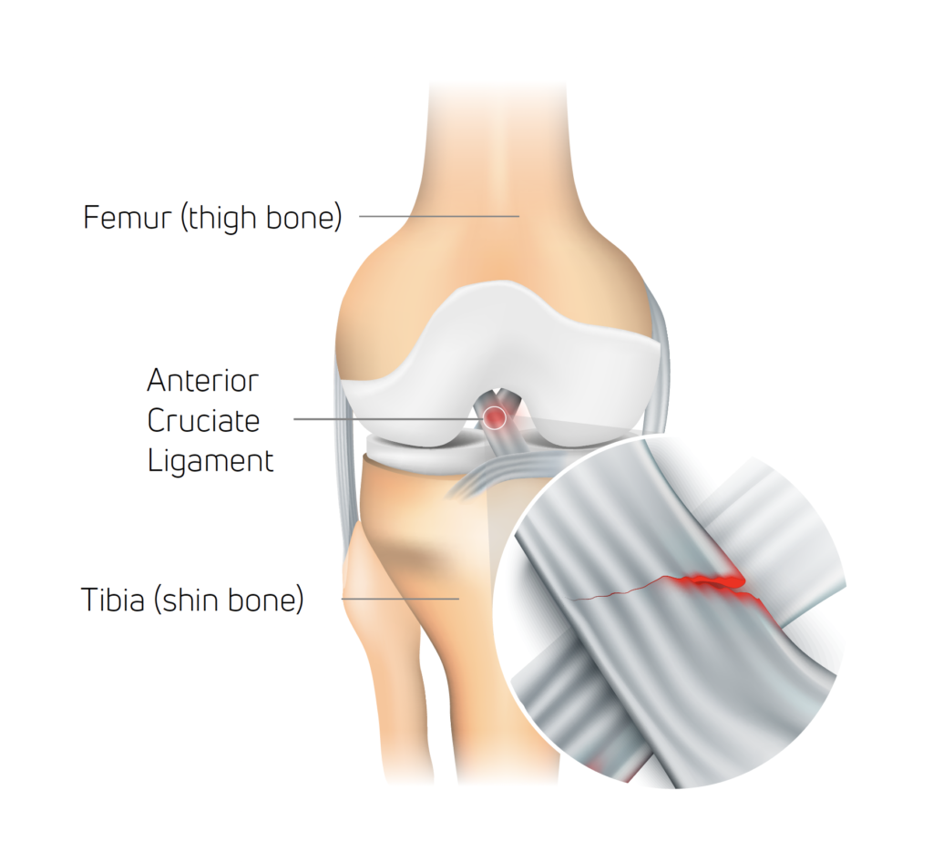 ACL Injury Treatment in Chandigarh