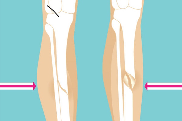 Bone Fractures: Types, Treatment, and Recovery Process