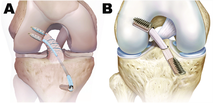 Advanced ACL Injury Treatments Offered by Specialists in Chandigarh