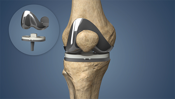 Choosing the Best Hospital for Knee Replacement Surgery in Chandigarh