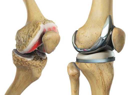 Top-Rated Knee Replacement Surgeons in Chandigarh