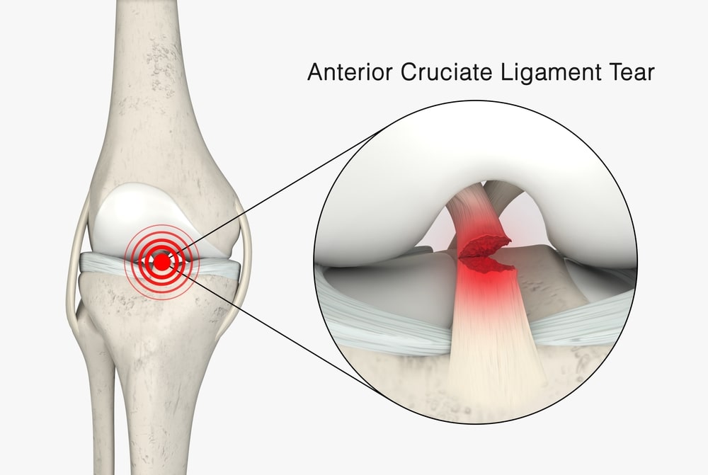 ACL Tear Treatment in Chandigarh: Advanced Solutions for Faster Recovery