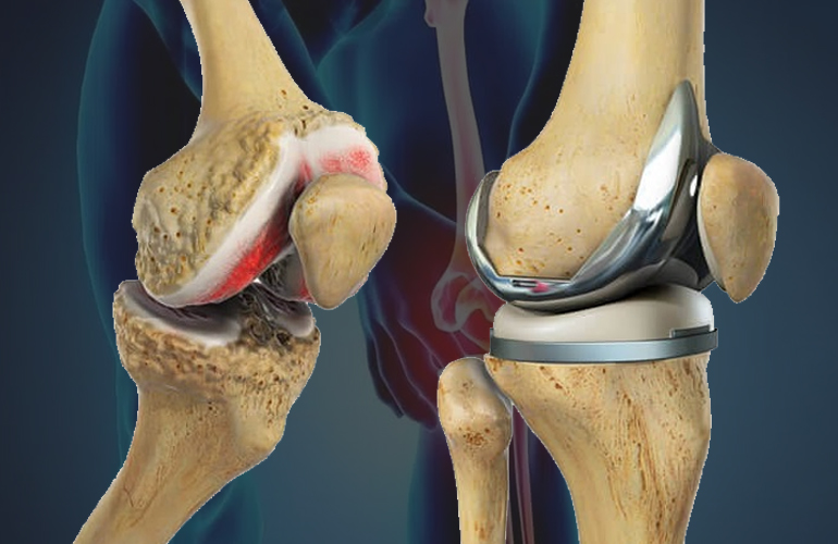 Affordable Knee Replacement in Chandigarh: Expert Care Within Your Budget