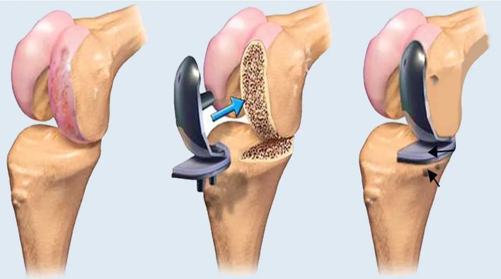 Affordable Knee Replacement Surgery in Chandigarh: Transforming Lives with Advanced Care