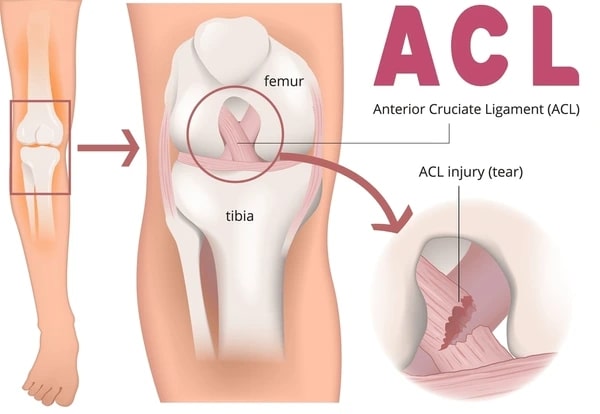 Orthopedic Specialists in Chandigarh: Expert Care for ACL Injuries