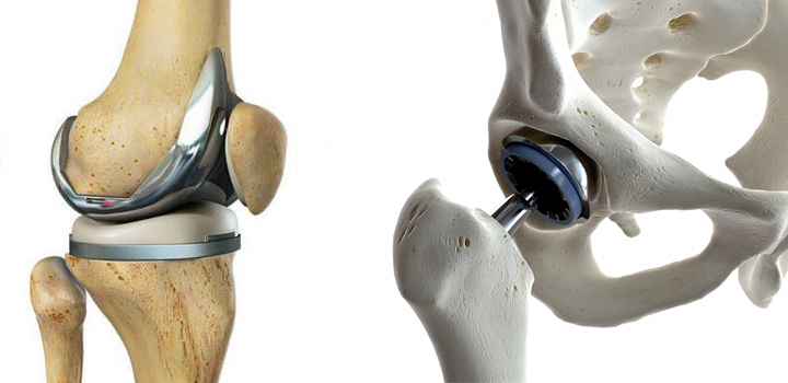 Advanced Joint Replacement Surgery: Best Hospitals in Chandigarh