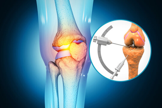 Knee Replacement Surgery in Chandigarh: Meet the Leading Experts