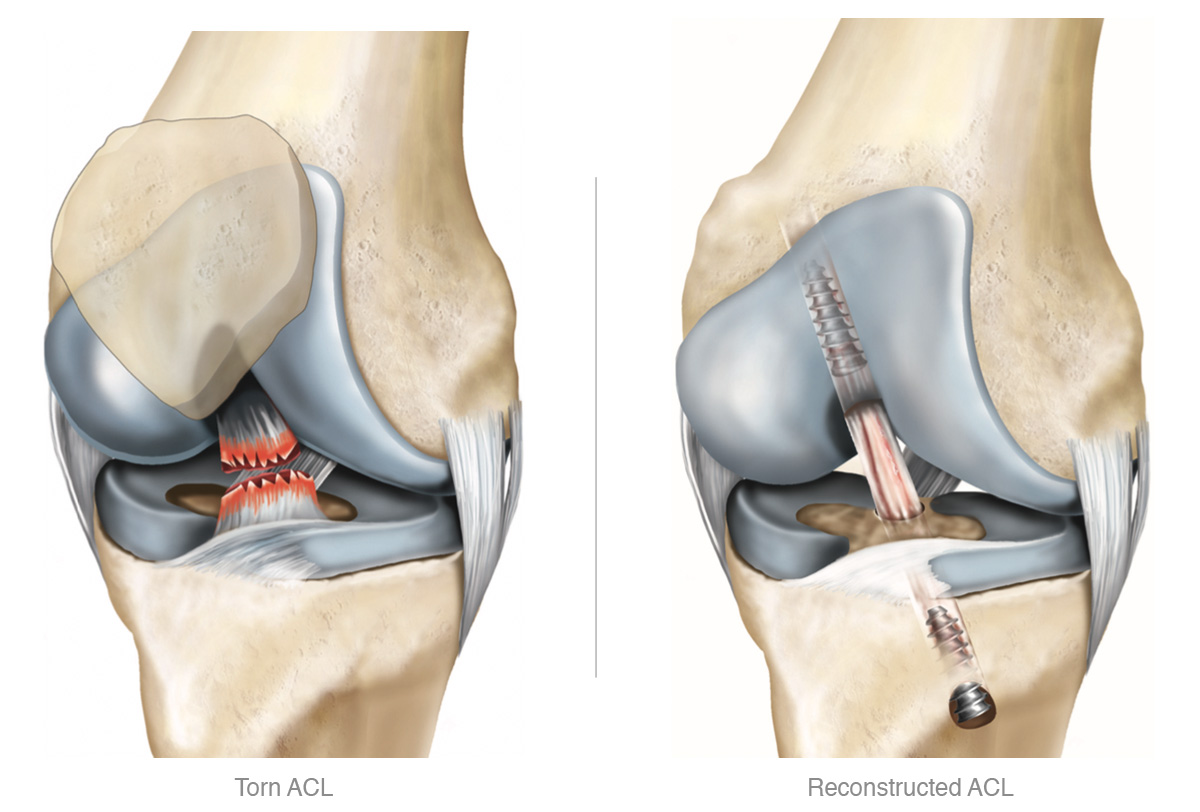 Best Knee Ligament Injury Treatment in Chandigarh: Get Back on Your Feet Faster