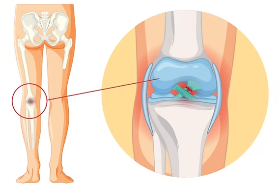 Choosing the Right Surgeon for Knee Joint Replacement in Chandigarh