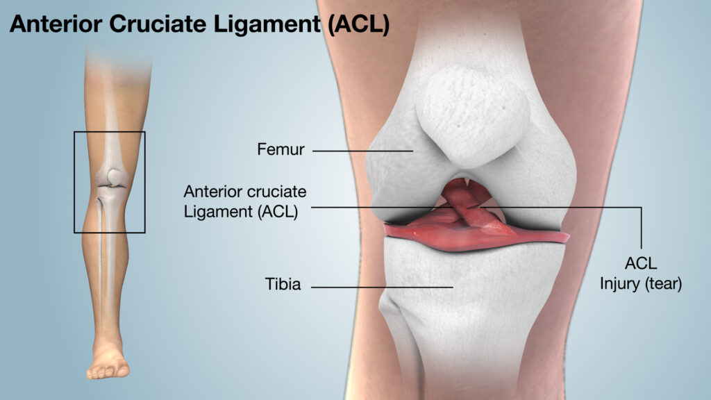 ACL Tear? Get the Best Treatment Options in Chandigarh