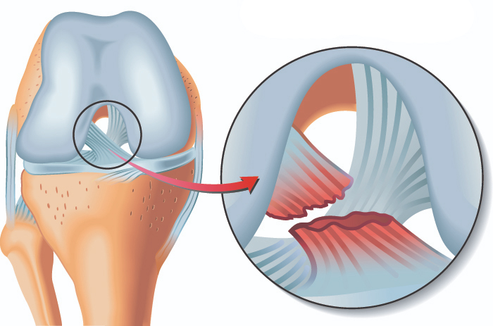 Expert Care for Ligament Injuries, Best Surgeons in Chandigarh Expert Care for Ligament Injuries, Best Surgeons in Chandigarh