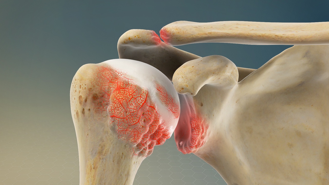 Shoulder Arthritis: Orthopedic Treatments That Actually Work