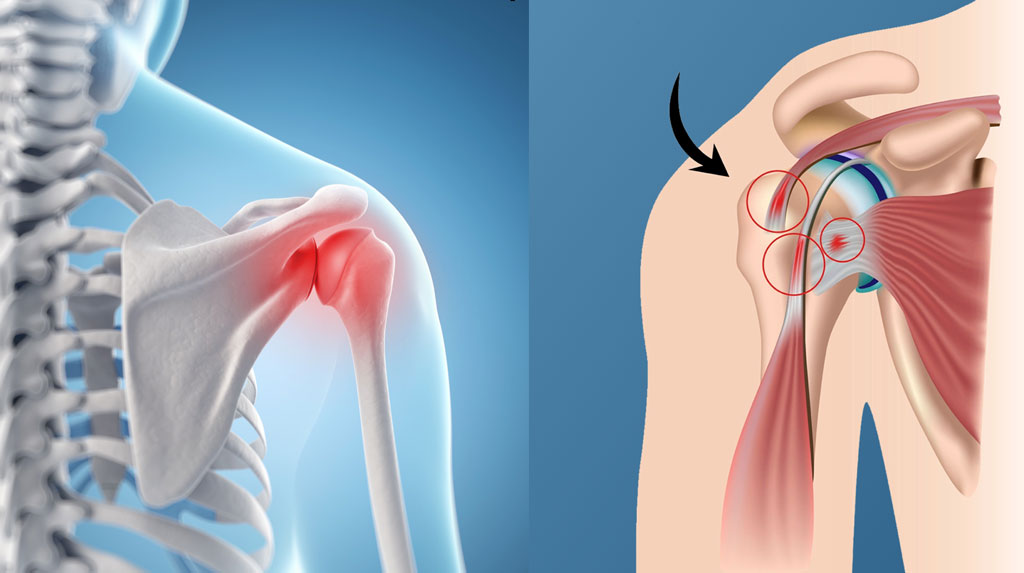 Understanding Shoulder Impingement and Its Treatment Understanding Shoulder Impingement and Its Treatment