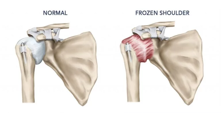 Frozen Shoulder: Causes, Symptoms, and Effective Treatments Frozen Shoulder: Causes, Symptoms, and Effective Treatments