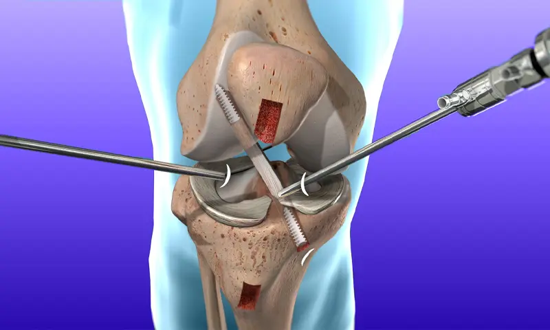 Chandigarh ACL Surgery Expert: Combining Experience with Modern Care