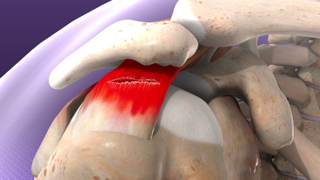 Understanding Rotator Cuff Injuries and Treatments