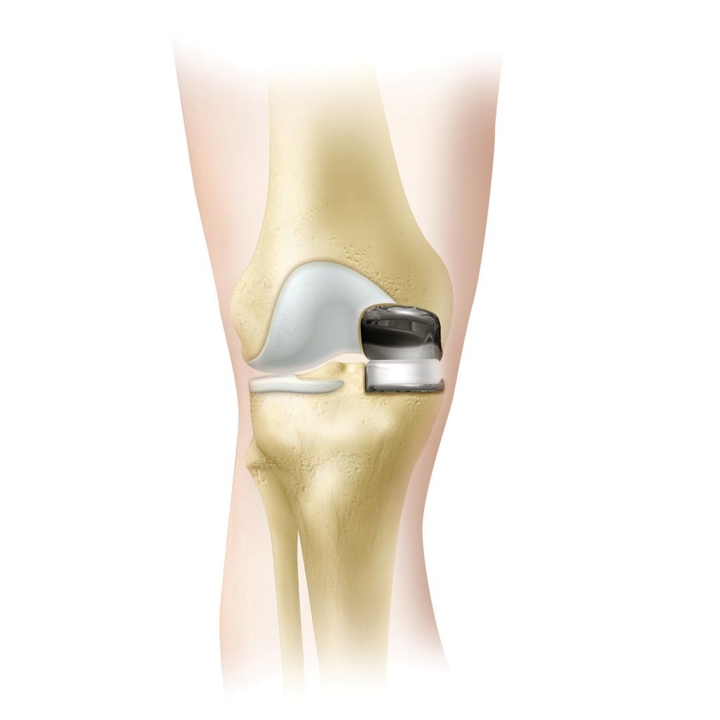 What Is Partial Knee Resurfacing? Complete Guide