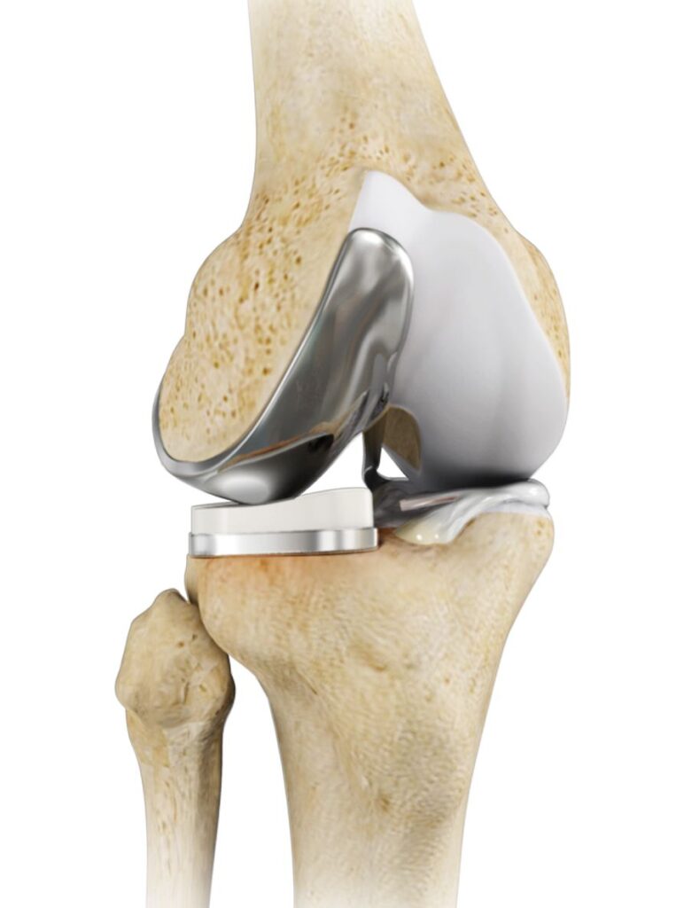 Robotic Knee Replacement: Is It Better Than Traditional Surgery?