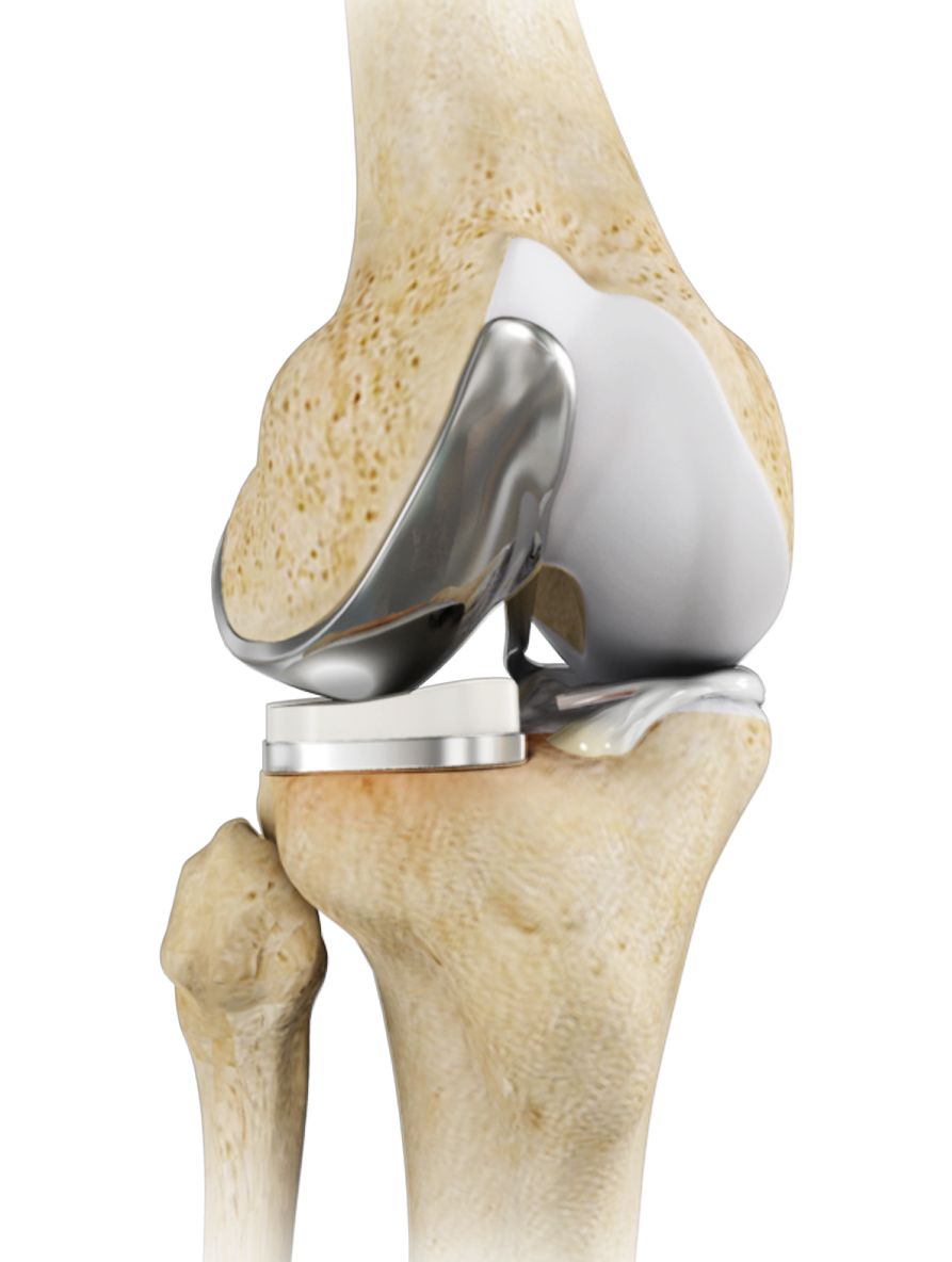 Robotic Knee Replacement: Is It Better Than Traditional Surgery?